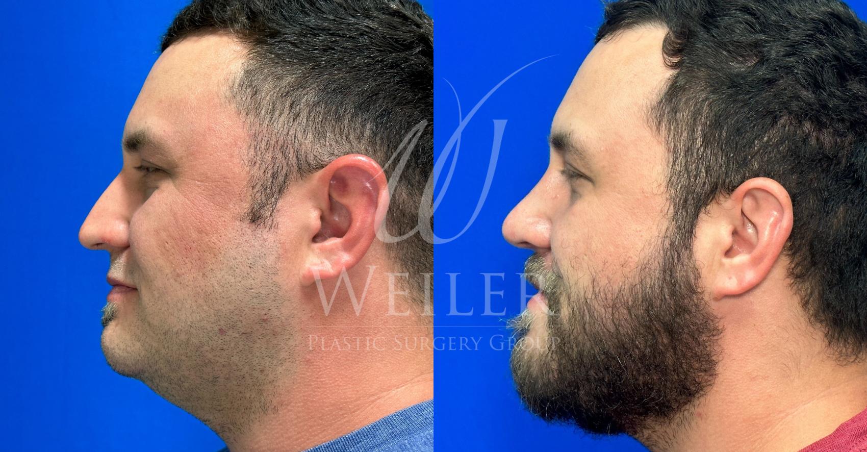 Before & After Rhinoplasty Case 1116 Right Side View in Baton Rouge, New Orleans, & Lafayette, Louisiana