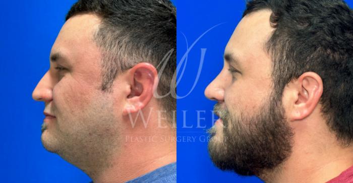 Before & After Rhinoplasty Case 1116 Right Side View in Baton Rouge, New Orleans, & Lafayette, Louisiana