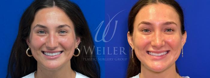 Before & After Rhinoplasty Case 1386 Front View in Baton Rouge, New Orleans, & Lafayette, Louisiana