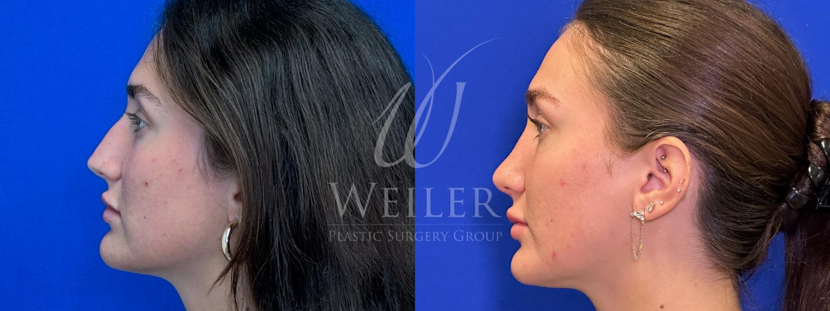 Before & After Rhinoplasty Case 1386 Left Side View in Baton Rouge, New Orleans, & Lafayette, Louisiana