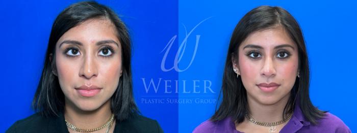 Before & After Rhinoplasty Case 1414 Front View in Baton Rouge, New Orleans, & Lafayette, Louisiana