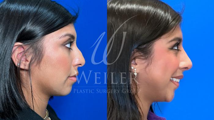 Before & After Rhinoplasty Case 1414 Right Side View in Baton Rouge, New Orleans, & Lafayette, Louisiana