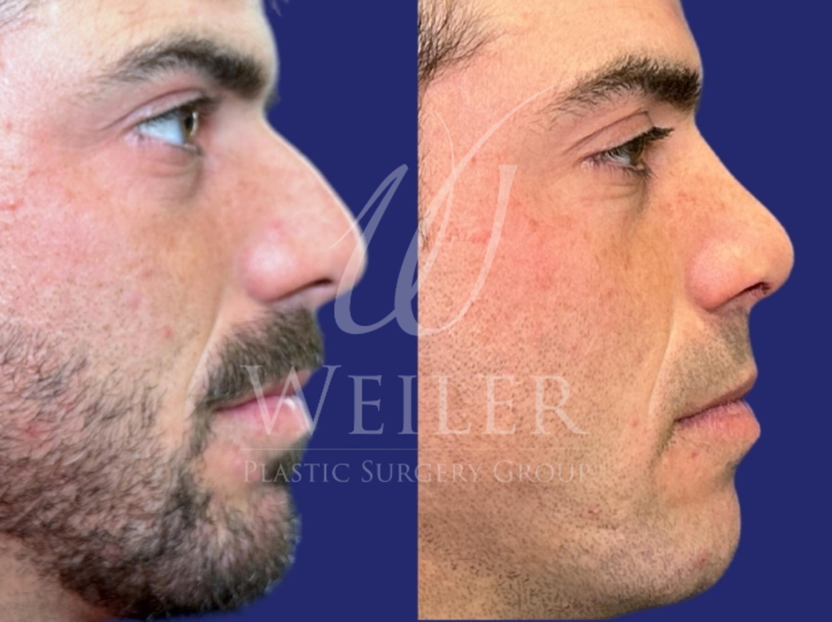 Before & After Rhinoplasty Case 1491 Right Side View in Baton Rouge, New Orleans, & Lafayette, Louisiana