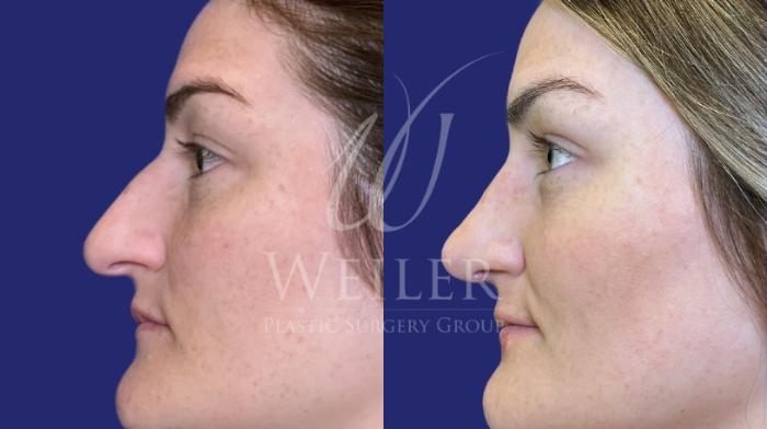 Before & After Rhinoplasty Case 1548 Left Side View in Baton Rouge, New Orleans, & Lafayette, Louisiana