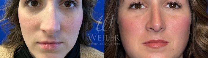 Before & After Rhinoplasty Case 1603 Front View in Baton Rouge, New Orleans, & Lafayette, Louisiana