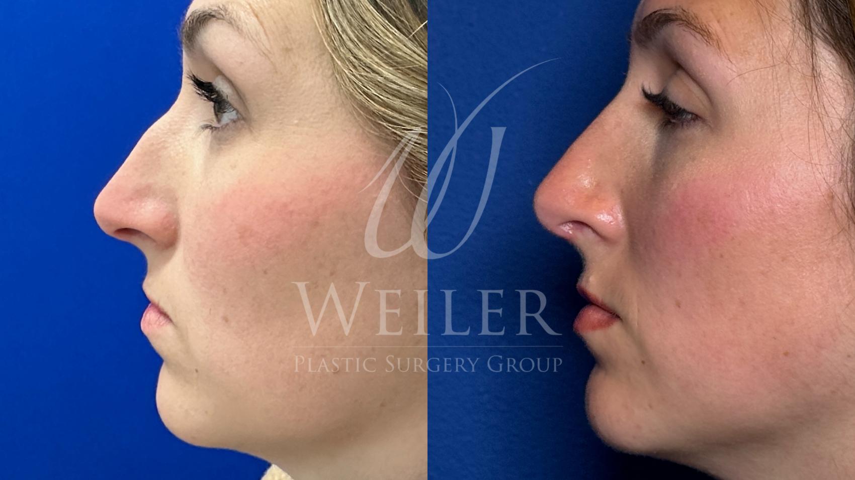 Before & After Rhinoplasty Case 1603 Left Side View in Baton Rouge, New Orleans, & Lafayette, Louisiana