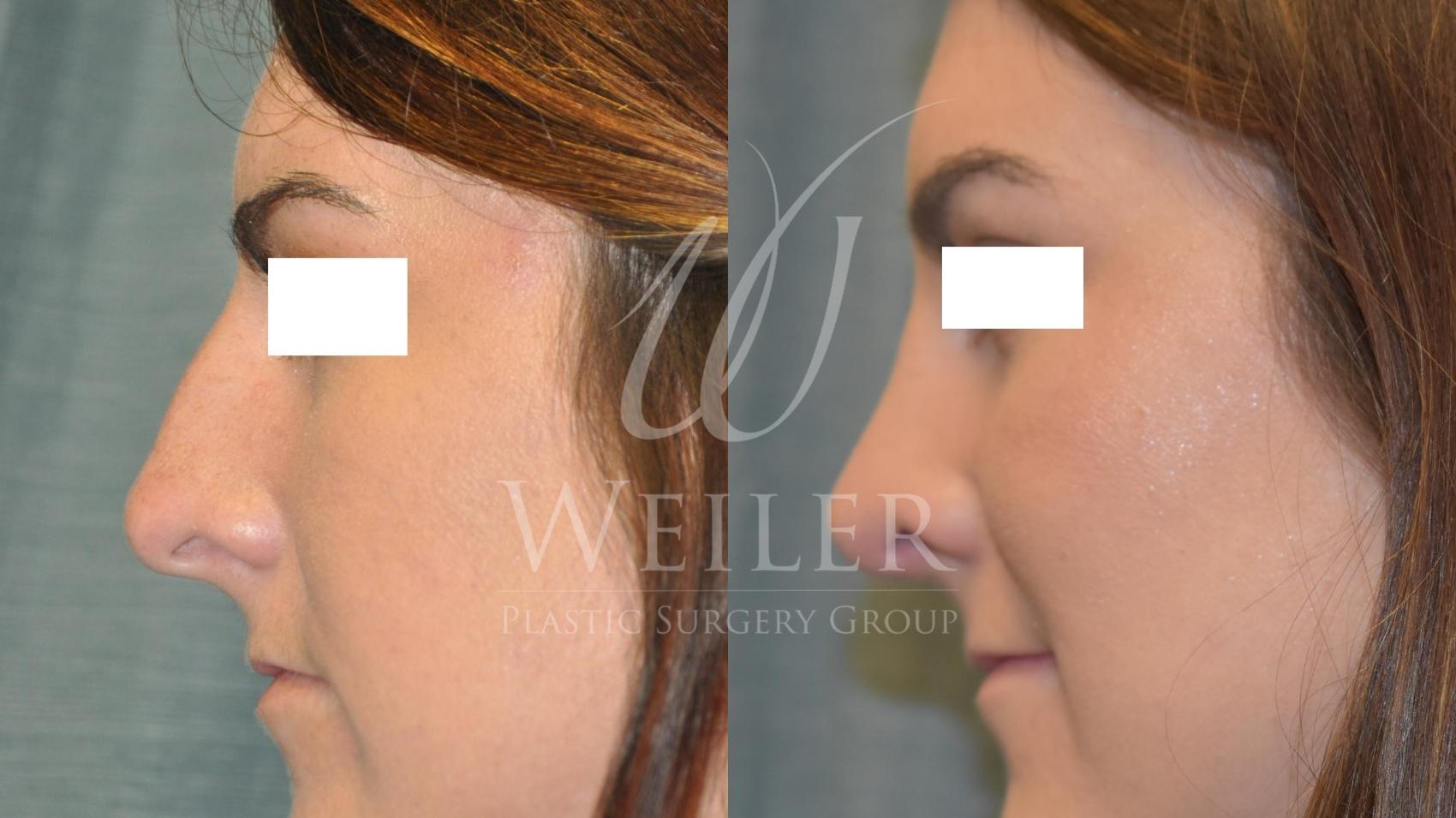 Before & After Rhinoplasty Case 166 View #1 View in Baton Rouge, Louisiana