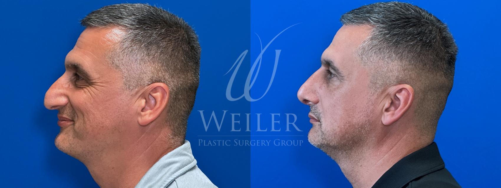 Before & After Rhinoplasty Case 1675 Left Side View in Baton Rouge, New Orleans, & Lafayette, Louisiana