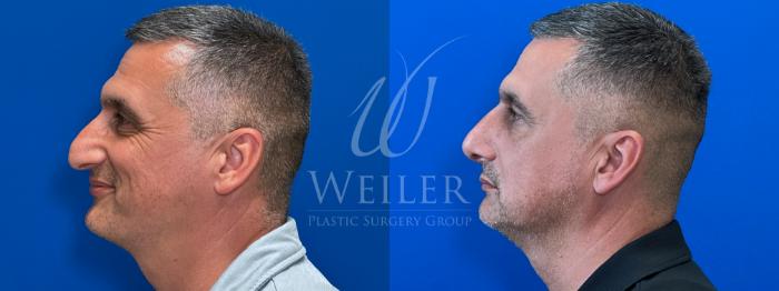 Before & After Rhinoplasty Case 1675 Left Side View in Baton Rouge, New Orleans, & Lafayette, Louisiana
