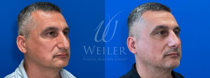 Before & After Rhinoplasty Case 1675 Right Oblique View in Baton Rouge, New Orleans, & Lafayette, Louisiana