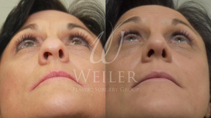 Before & After Rhinoplasty Case 272 View #1 View in Baton Rouge, New Orleans, & Lafayette, Louisiana