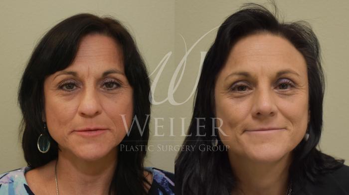 Before & After Rhinoplasty Case 272 View #2 View in Baton Rouge, New Orleans, & Lafayette, Louisiana