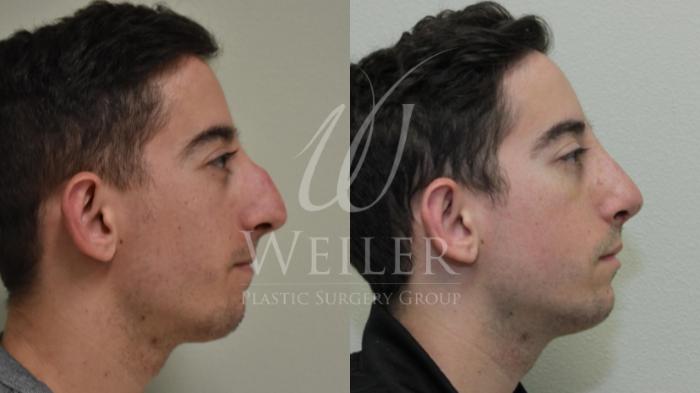 Before & After Rhinoplasty Case 286 View #1 View in Baton Rouge, New Orleans, & Lafayette, Louisiana