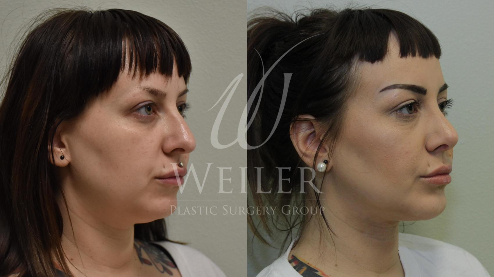 Before & After Rhinoplasty Case 386 View #1 View in Baton Rouge, Louisiana