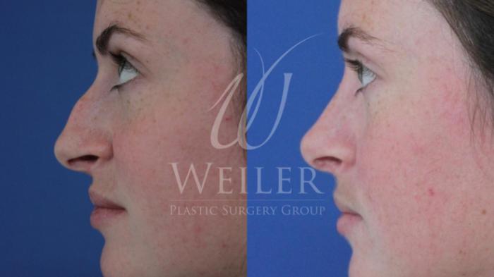 Before & After Rhinoplasty Case 432 View #1 View in Baton Rouge, Louisiana