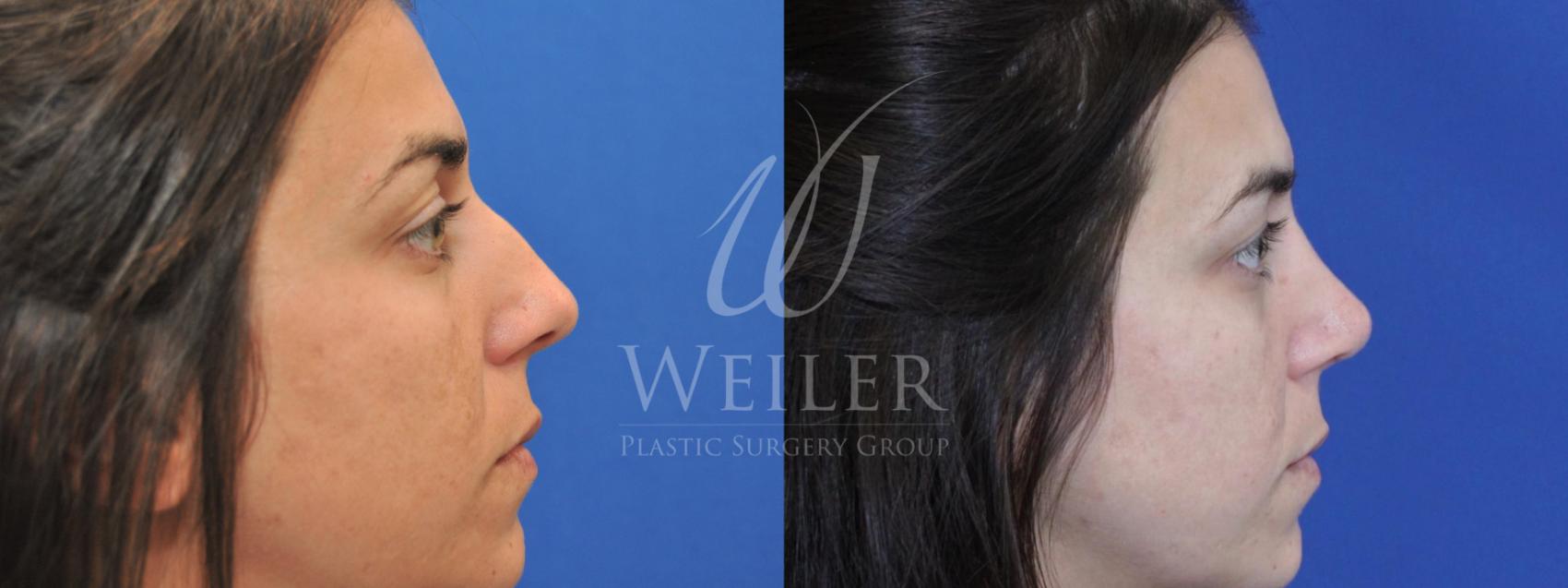 Before & After Rhinoplasty Case 552 Right Side View in Baton Rouge, Louisiana
