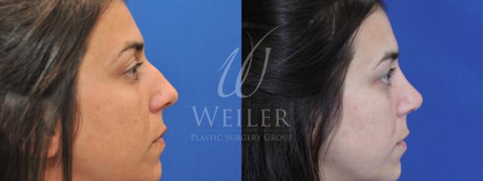Before & After Rhinoplasty Case 552 Right Side View in Baton Rouge, New Orleans, & Lafayette, Louisiana