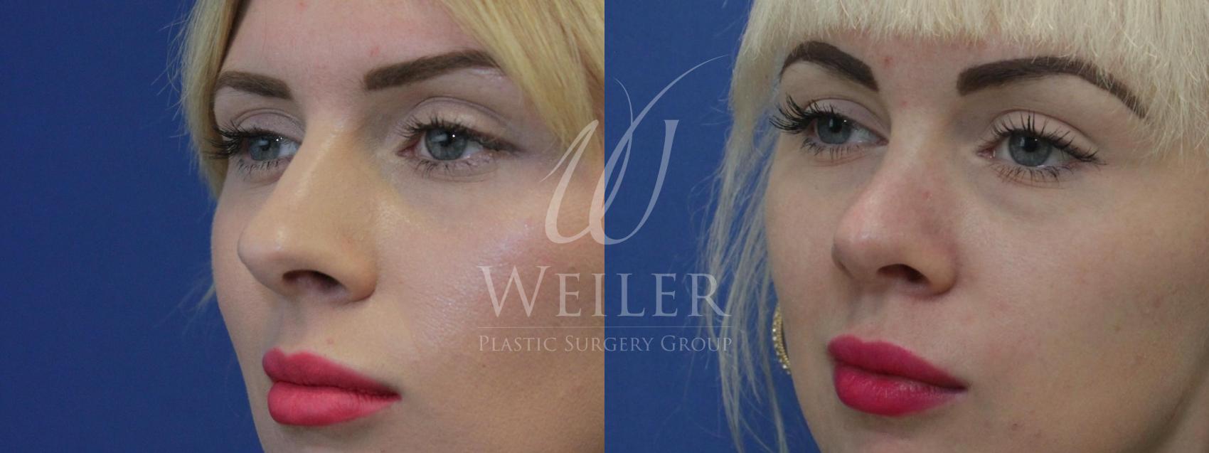 Before & After Rhinoplasty Case 588 Left Oblique View in Baton Rouge, Louisiana