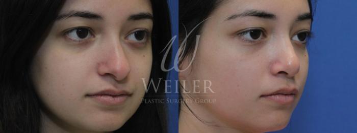 Before & After Rhinoplasty Case 589 Right Oblique View in Baton Rouge, Louisiana