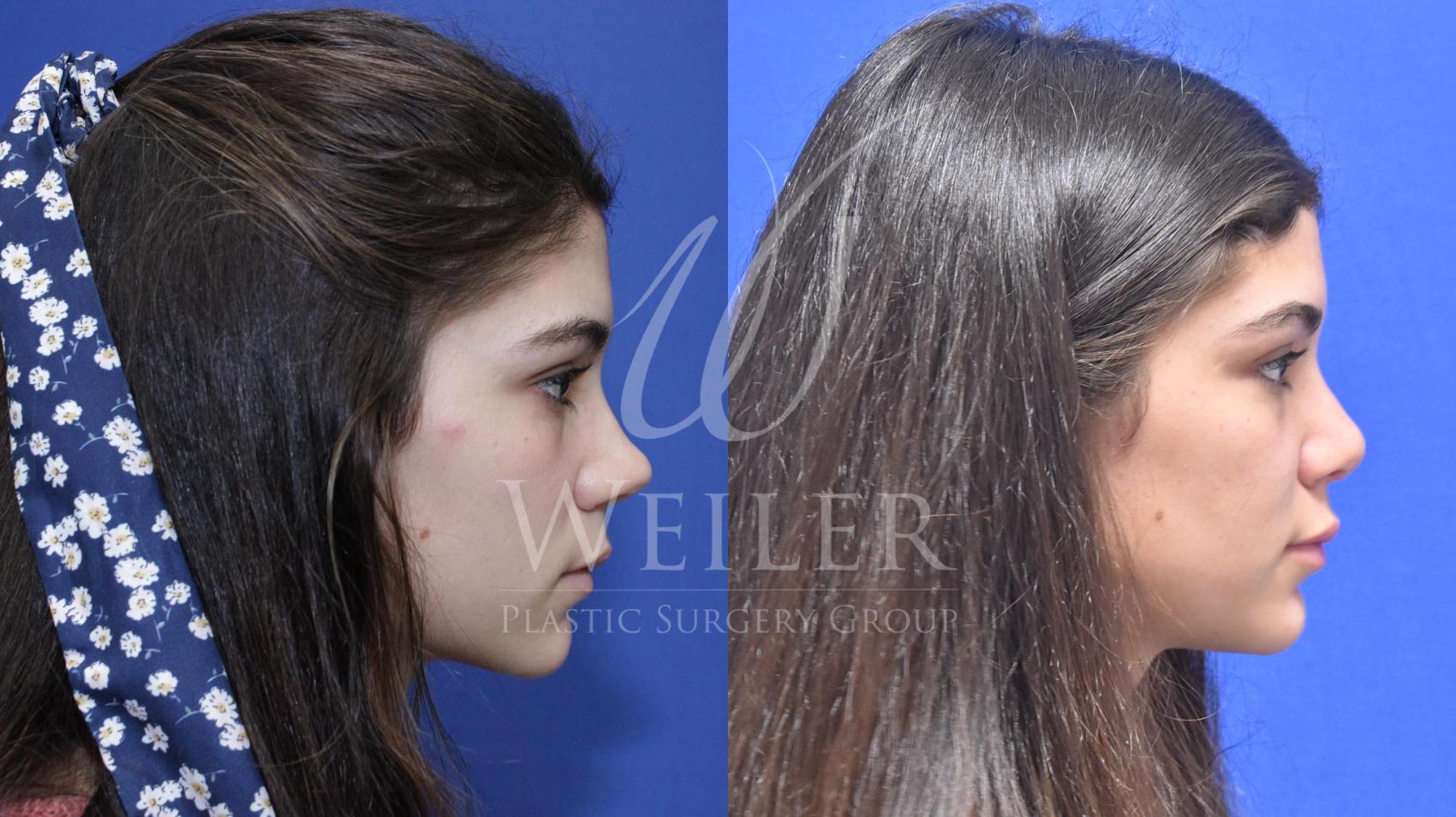 Before & After Rhinoplasty Case 639 Right Side View in Baton Rouge, Louisiana