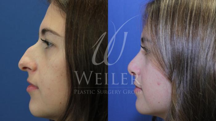 Before & After Rhinoplasty Case 707 Left Side View in Baton Rouge, Louisiana