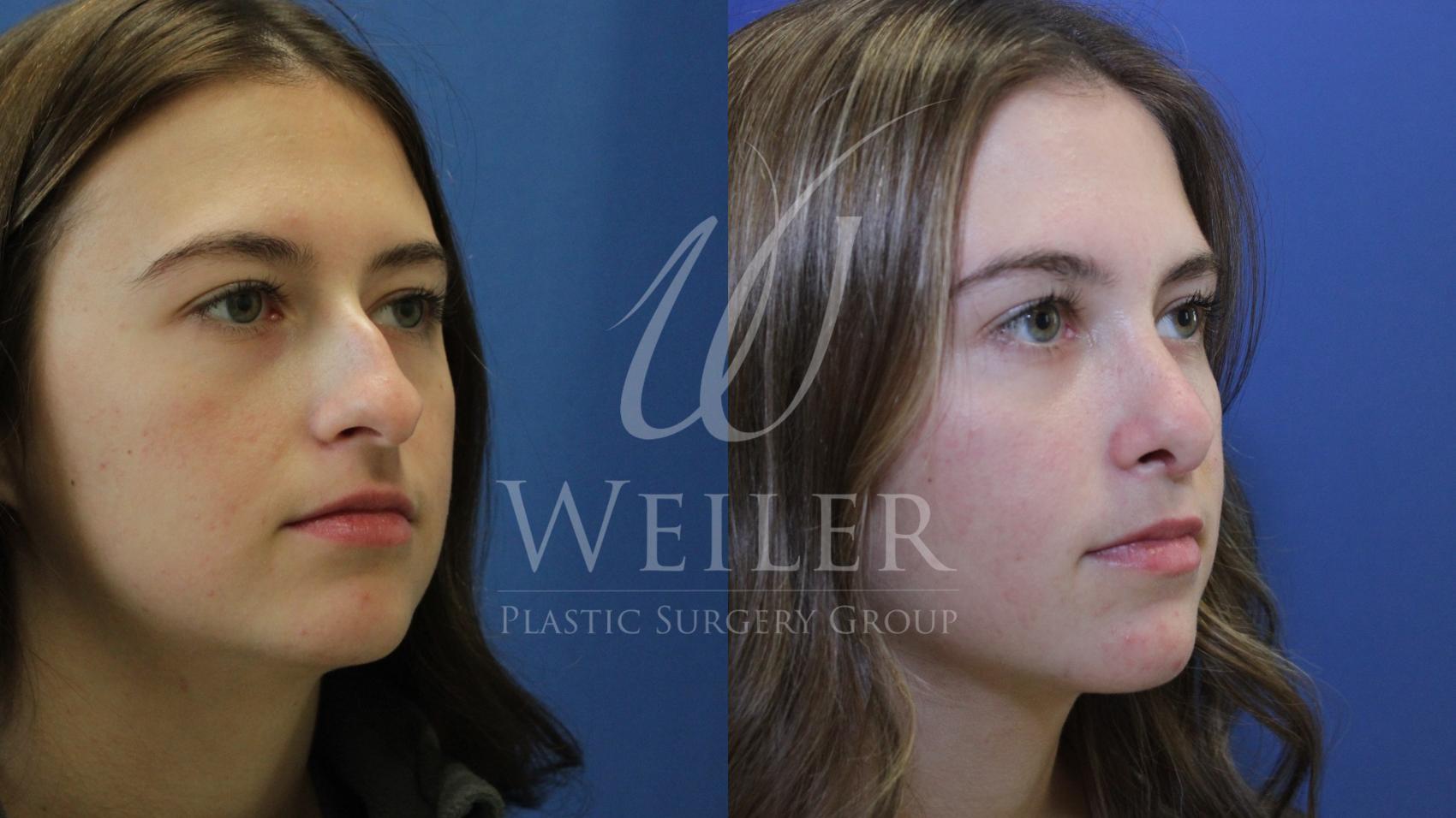 Before & After Rhinoplasty Case 707 Right Oblique View in Baton Rouge, Louisiana