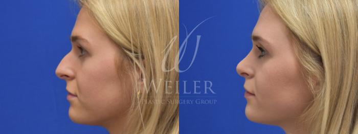 Before & After Rhinoplasty Case 749 Left Side View in Baton Rouge, Louisiana
