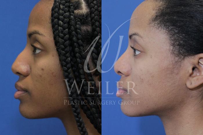 Before & After Rhinoplasty Case 836 Left Side View in Baton Rouge, New Orleans, & Lafayette, Louisiana