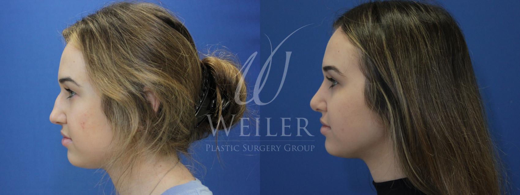 Before & After Rhinoplasty Case 849 Left Side View in Baton Rouge, Louisiana
