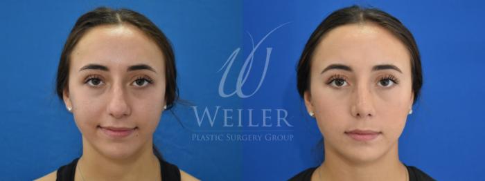 Before & After Rhinoplasty Case 881 Front View in Baton Rouge, Louisiana