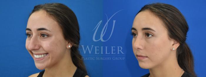 Before & After Rhinoplasty Case 881 Left Oblique View in Baton Rouge, Louisiana