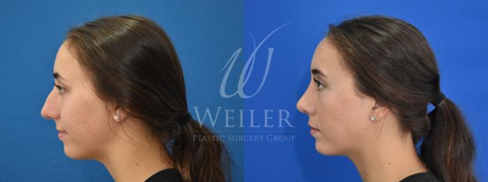 Before & After Rhinoplasty Case 881 Left Side View in Baton Rouge, Louisiana