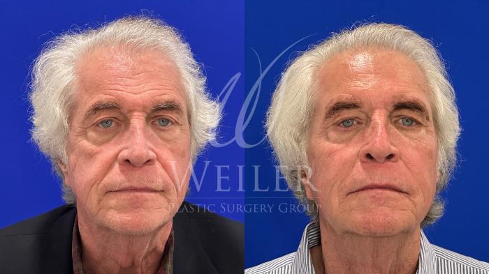 Before & After Sculptra Case 1595 Front View in Baton Rouge, New Orleans, & Lafayette, Louisiana
