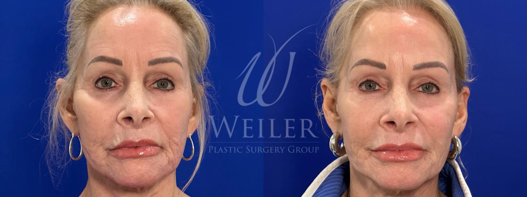 Before & After Sculptra Case 1601 Front View in Baton Rouge, New Orleans, & Lafayette, Louisiana