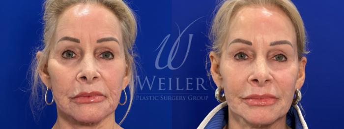 Before & After Sculptra Case 1601 Front View in Baton Rouge, New Orleans, & Lafayette, Louisiana