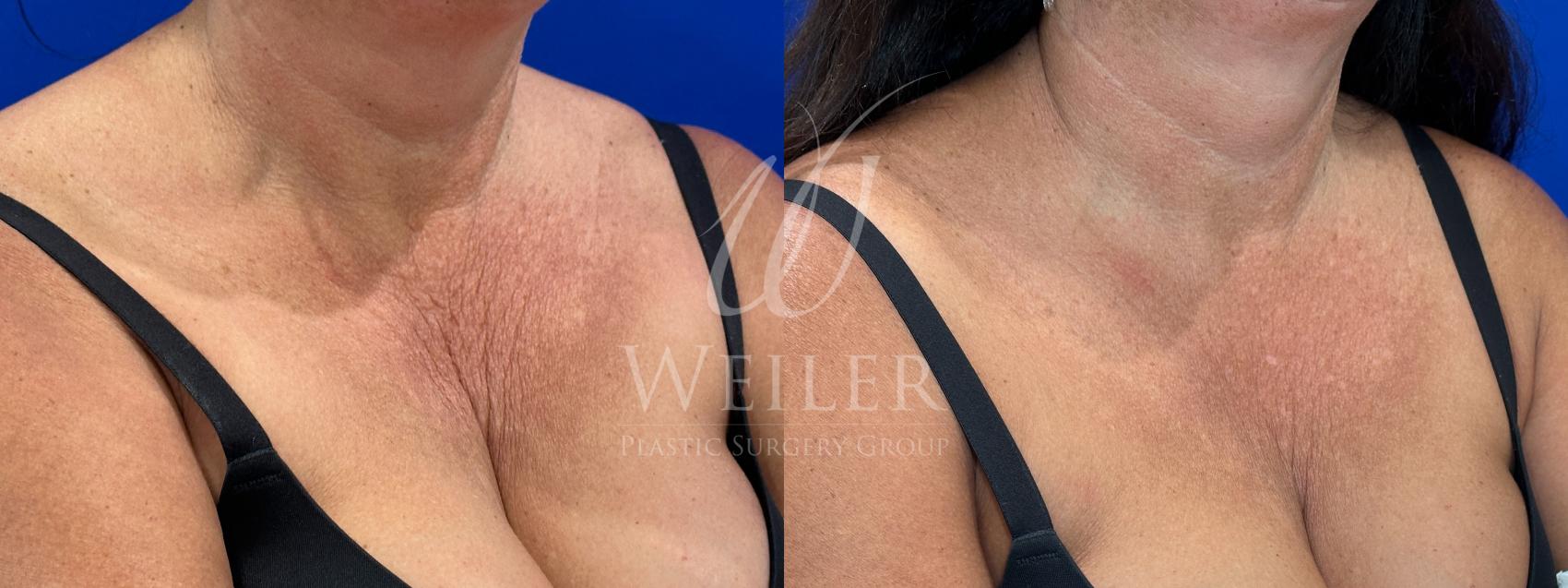 Before & After Sculptra Case 1602 Right Oblique View in Baton Rouge, New Orleans, & Lafayette, Louisiana