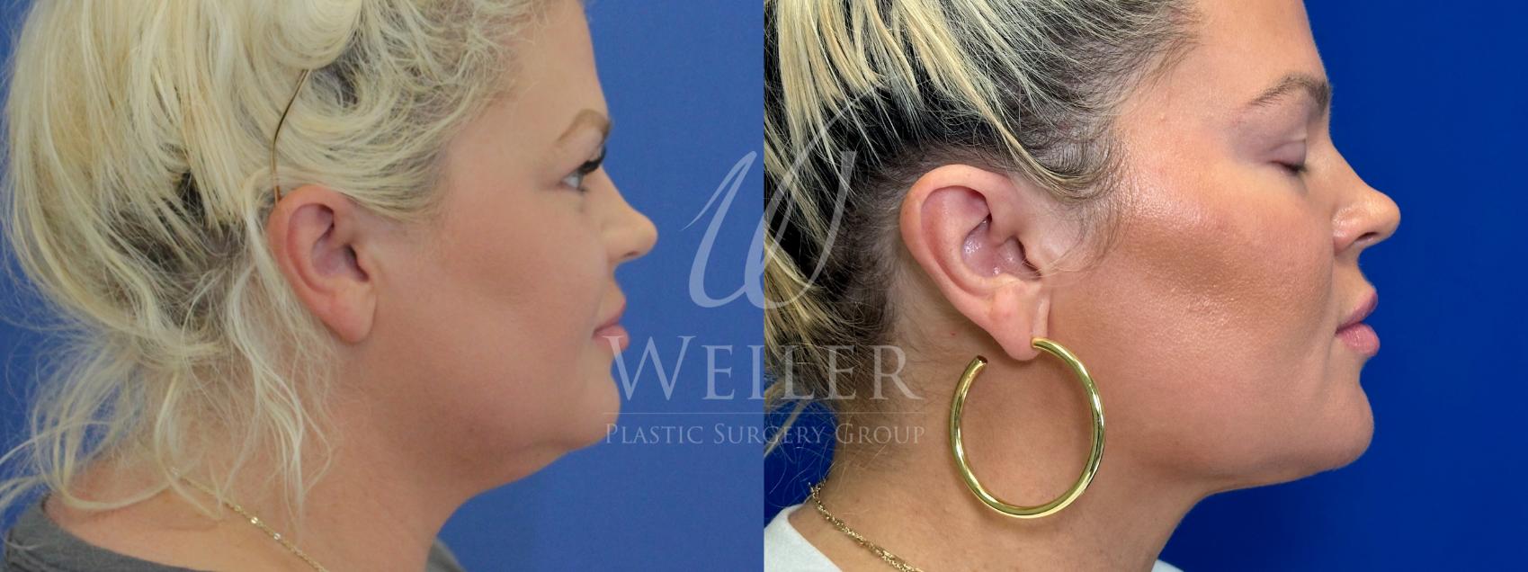 Before & After Submental Liposuction Case 1022 Right Side View in Baton Rouge, New Orleans, & Lafayette, Louisiana