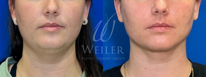 Before & After Submental Liposuction Case 1311 Front View in Baton Rouge, New Orleans, & Lafayette, Louisiana