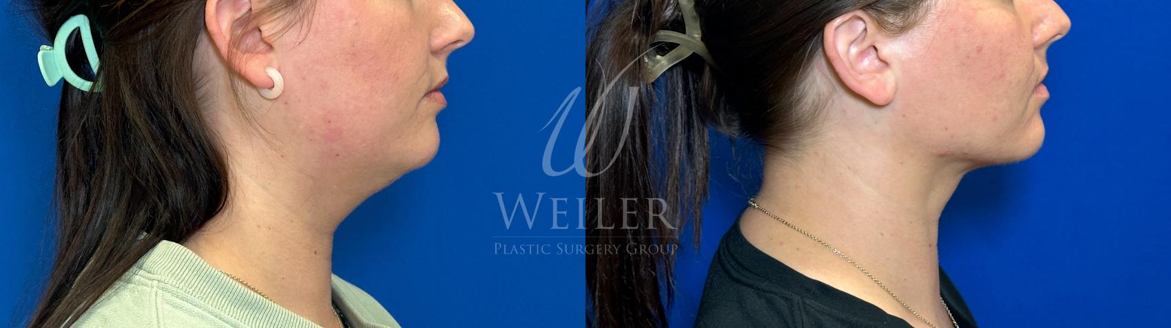 Before & After Submental Liposuction Case 1311 Left Side View in Baton Rouge, New Orleans, & Lafayette, Louisiana