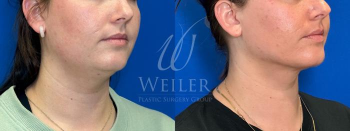 Before & After Submental Liposuction Case 1311 Right Oblique View in Baton Rouge, New Orleans, & Lafayette, Louisiana