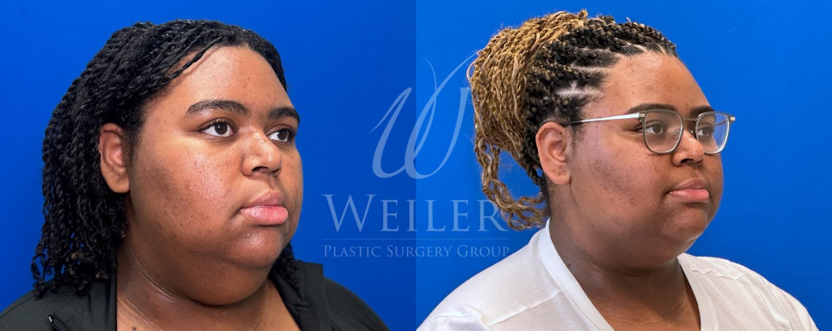 Before & After Submental Liposuction Case 1366 Right Oblique View in Baton Rouge, New Orleans, & Lafayette, Louisiana