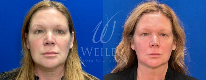 Before & After Submental Liposuction Case 1412 Front View in Baton Rouge, New Orleans, & Lafayette, Louisiana