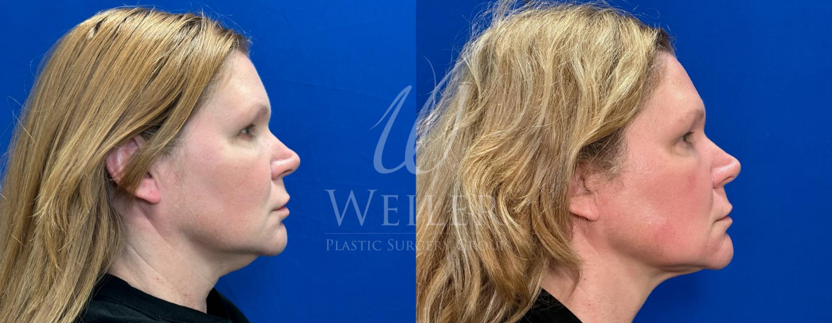 Before & After Submental Liposuction Case 1412 Right Side View in Baton Rouge, New Orleans, & Lafayette, Louisiana