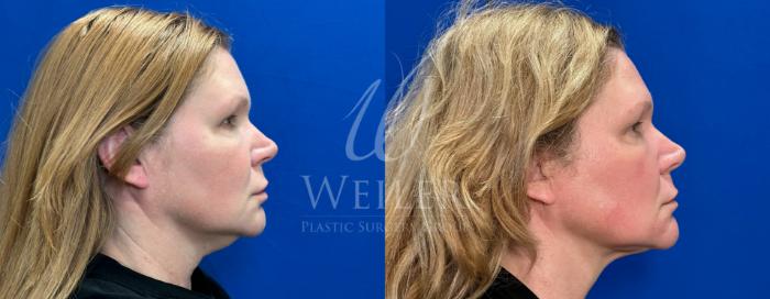 Before & After Submental Liposuction Case 1412 Right Side View in Baton Rouge, New Orleans, & Lafayette, Louisiana