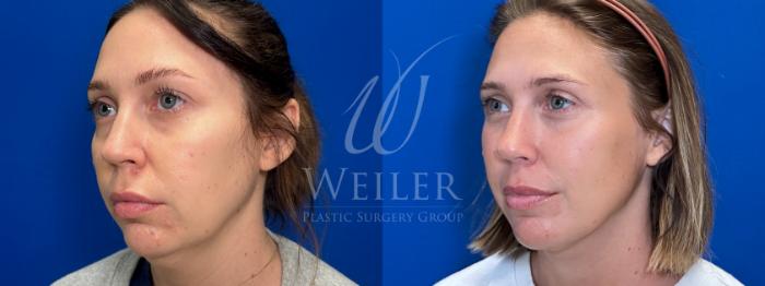 Before & After Submental Liposuction Case 1444 Left Oblique View in Baton Rouge, New Orleans, & Lafayette, Louisiana