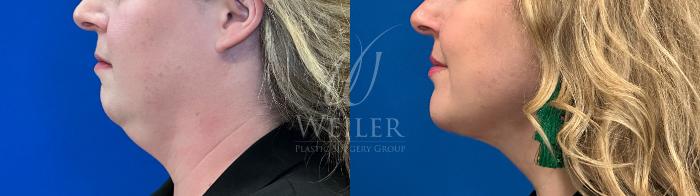 Before & After Submental Liposuction Case 1458 Left Side View in Baton Rouge, New Orleans, & Lafayette, Louisiana