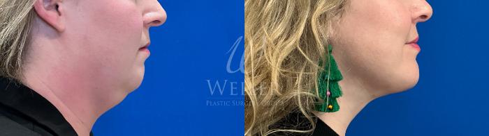 Before & After Submental Liposuction Case 1458 Right Side View in Baton Rouge, New Orleans, & Lafayette, Louisiana