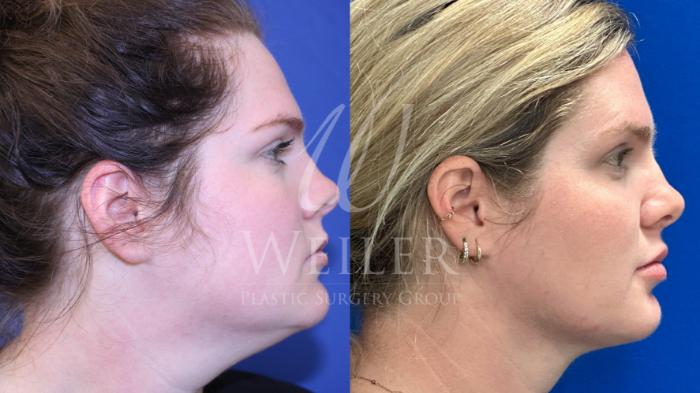 Before & After Submental Liposuction Case 1486 Right Side View in Baton Rouge, New Orleans, & Lafayette, Louisiana