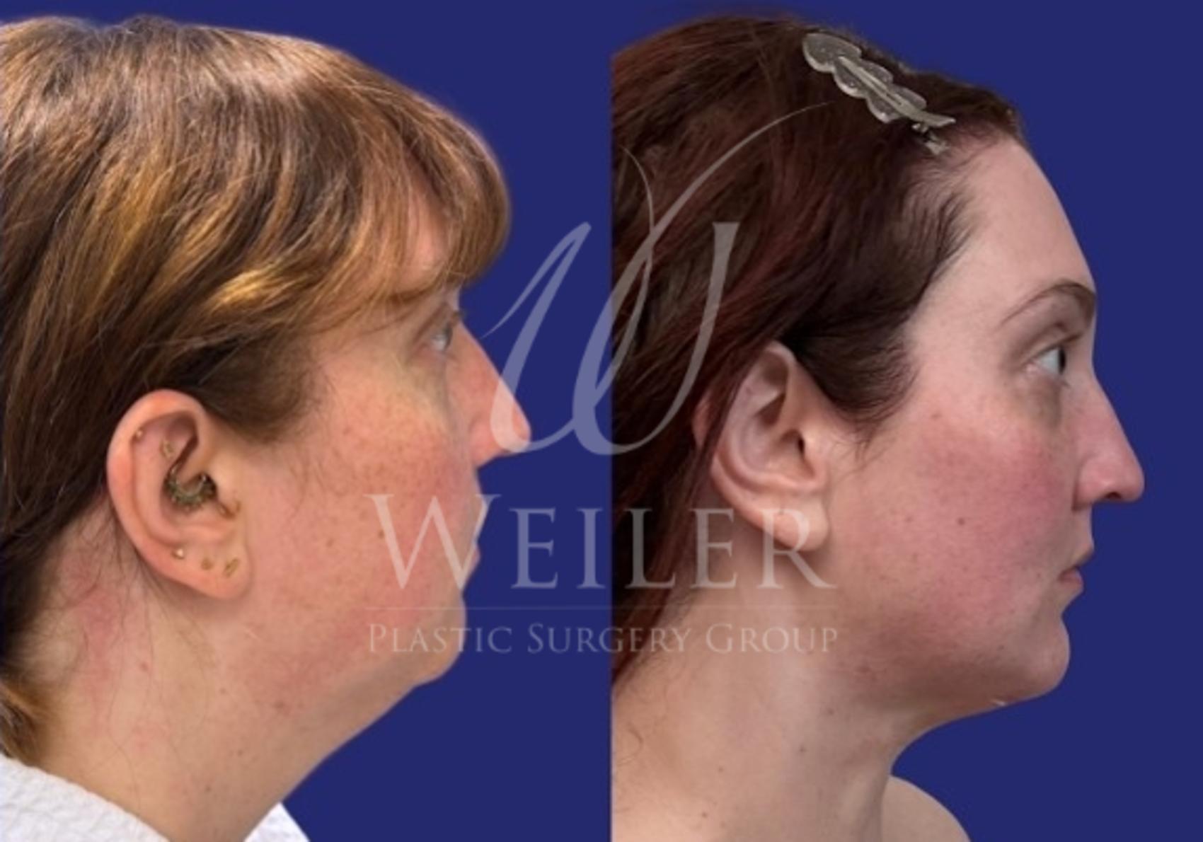 Before & After Submental Liposuction Case 1732 Right Side View in Baton Rouge, New Orleans, & Lafayette, Louisiana