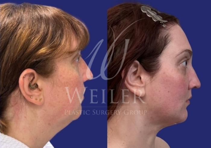 Before & After Submental Liposuction Case 1732 Right Side View in Baton Rouge, New Orleans, & Lafayette, Louisiana